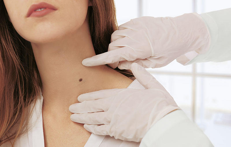 Hautarzt untersucht Leberfleck am Hals einer Frau