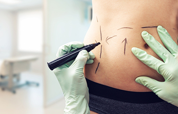 Foto, auf dem Arzt schwarze Markierungen für eine Schönheitsoperation auf einen weiblichen Bauch zeichnet