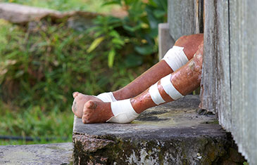 Foto von Missbildungen an Beinen und Füßen durch Lepra