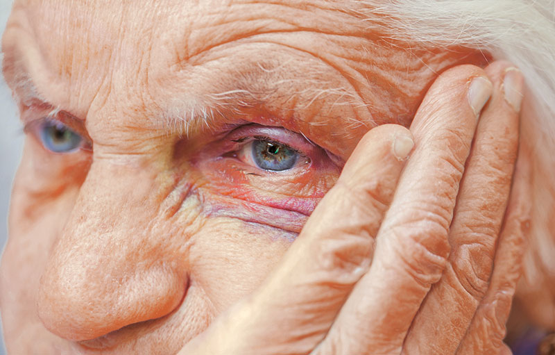 Symbolbild eines sehr alten Menschen, der sich ein rotgeschlagenes Auge hält